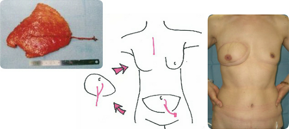 腹部の組織を使う方法写真１
